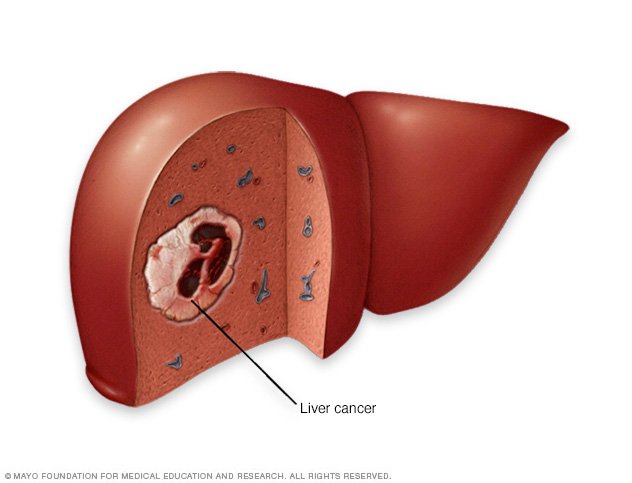 affects on liver Liver damage and also hepatoxic effects like cirrhosis are caused by chronic use of marijuana there are adverse effects like stomach pain, dark urine, vomiting, liver function abnormalities, acute hepatitis. affects on liver Liver damage and also hepatoxic effects like cirrhosis are caused by chronic use of marijuana there are adverse effects like stomach pain, dark urine, vomiting, liver function abnormalities, acute hepatitis.